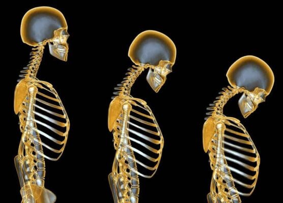 osteoporosi