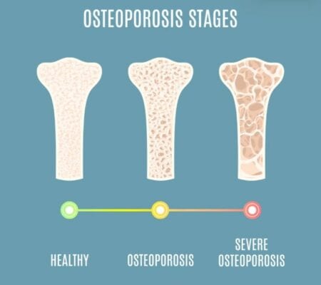 stadia osteoporosis