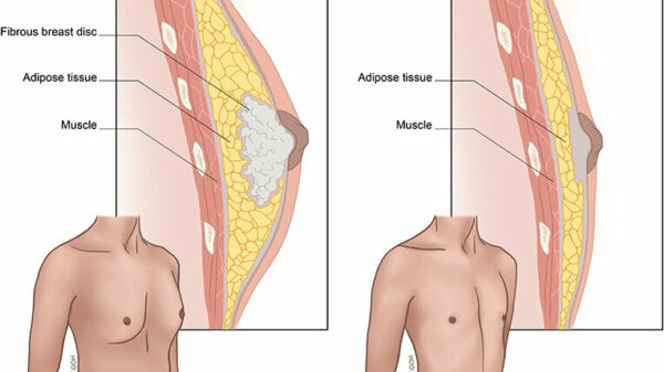 Γυναικομαστία 5 Gynecomastia