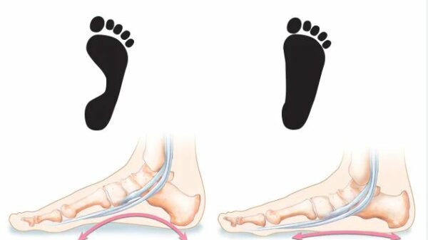Πλατυποδία ασκήσεις 4 flatfeet